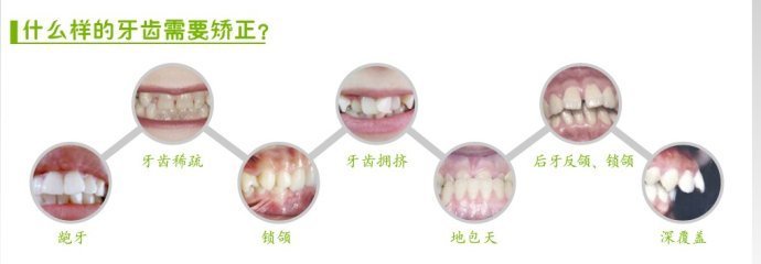 延安急性智齿冠周炎整形术做几次能持续永久